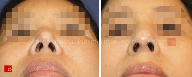 	Harmony-Rhinoplasty, Protruded Mouth Correction Rhinoplasty, Rib cartilage Rhinoplasty, Contracted Nose, Revision Rhinoplasty	 - Harmony rhinoplasty - 100% Rib cartilage