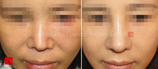 	Harmony-Rhinoplasty, Protruded Mouth Correction Rhinoplasty, Rib cartilage Rhinoplasty, Contracted Nose, Revision Rhinoplasty	 - Harmony rhinoplasty - 100% Rib cartilage