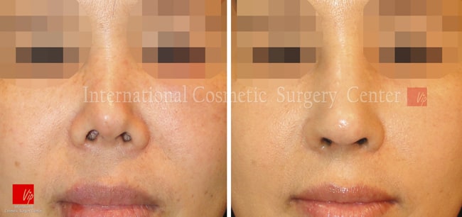 	Harmony-Rhinoplasty, Protruded Mouth Correction Rhinoplasty, Rib cartilage Rhinoplasty, Contracted Nose, Revision Rhinoplasty	 - Harmony rhinoplasty - 100% Rib cartilage