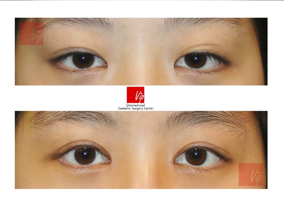 	Eye Surgery, Epicanthoplasty	 - Epicanthoplasty