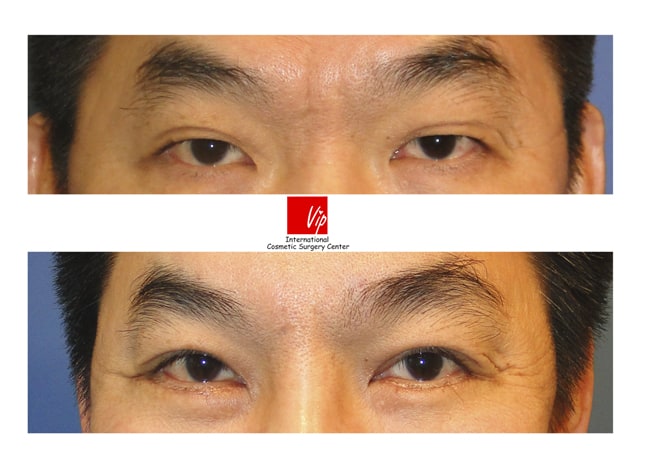 	Eye Surgery, Ptosis Correction	 - Forehead endoscope surgery & Upper blepharoplasty
