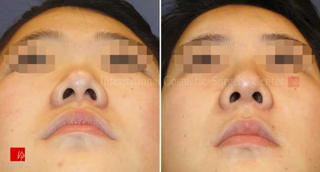 	Nose Surgery, Harmony-Rhinoplasty, Rib cartilage Rhinoplasty	 - Harmony line rhinoplasty