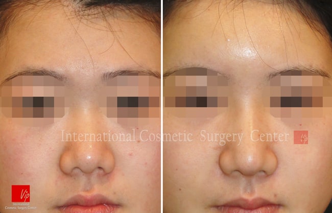 	Nose Surgery, Harmony-Rhinoplasty, Rib cartilage Rhinoplasty	 - Harmony line rhinoplasty