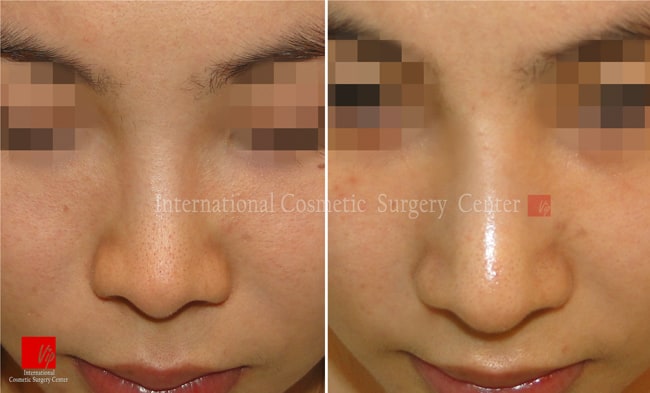 	Harmony-Rhinoplasty, Protruded Mouth Correction Rhinoplasty, Revision Rhinoplasty	 - Rib cartilage rhinoplasty-silicone infection