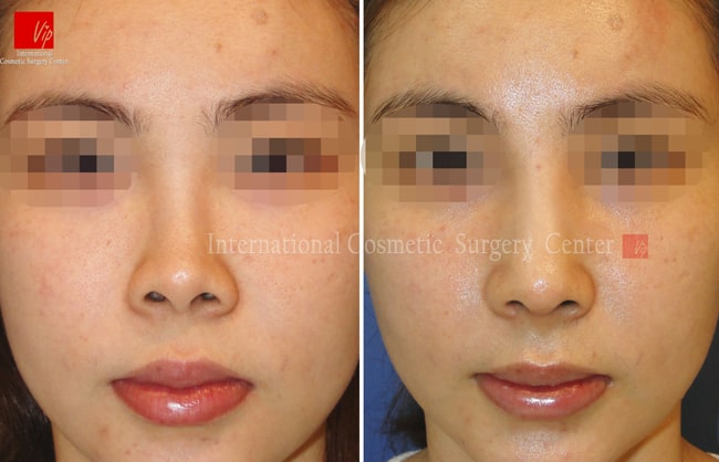 	Harmony-Rhinoplasty, Protruded Mouth Correction Rhinoplasty, Revision Rhinoplasty	 - Rib cartilage rhinoplasty-silicone infection