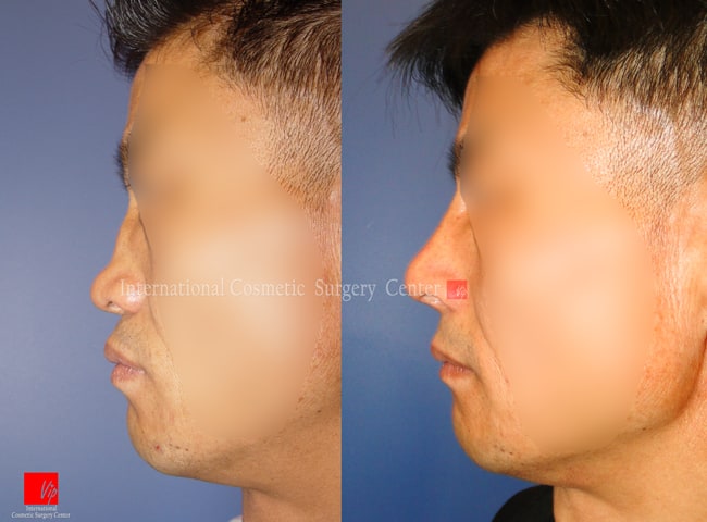	Harmony-Rhinoplasty, Protruded Mouth Correction Rhinoplasty, Rib cartilage Rhinoplasty	 - Flat nose correction with Rib cartilage (collapsed due to failure of septal deviation correction)