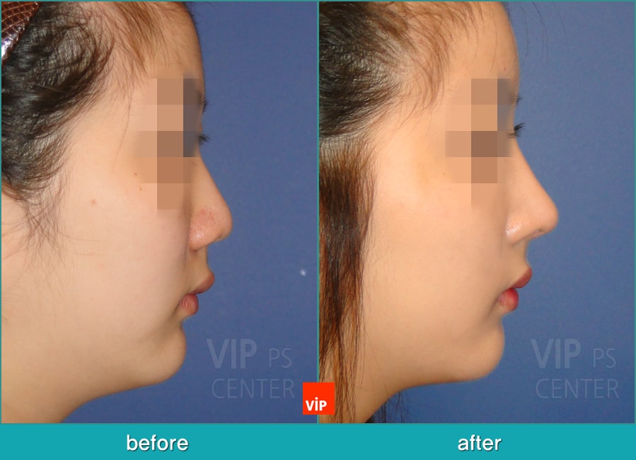 	Nose Surgery, Each Cases Nose, Septal Deviation	 - Septal Deviation