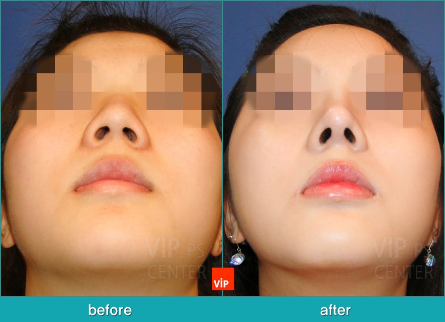 	Nose Surgery, Each Cases Nose, Septal Deviation	 - Septal Deviation