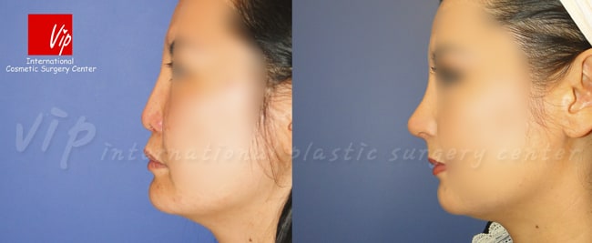 	Harmony-Rhinoplasty, Protruded Mouth Correction Rhinoplasty, Revision Rhinoplasty	 - Harmony rhinoplasty  using Rib cartilage