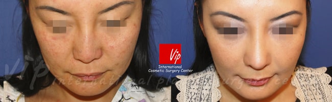 	Harmony-Rhinoplasty, Protruded Mouth Correction Rhinoplasty, Revision Rhinoplasty	 - Harmony rhinoplasty  using Rib cartilage