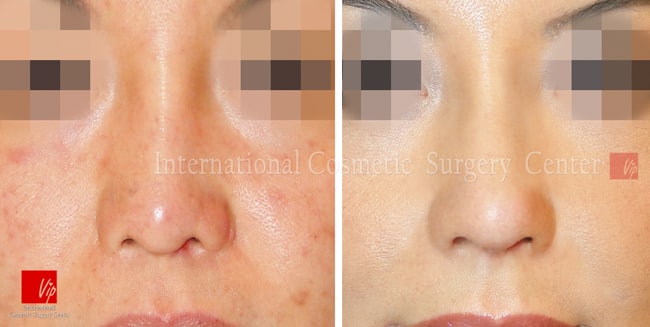 	Harmony-Rhinoplasty, Protruded Mouth Correction Rhinoplasty, Revision Rhinoplasty	 - Harmony rhinoplasty  using Rib cartilage