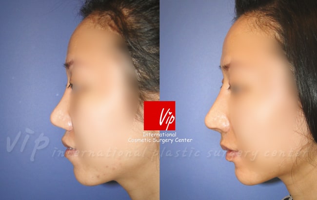 	Nose Surgery, Protruded Mouth Correction Rhinoplasty, Rib cartilage Rhinoplasty	 - Autologous rhinoplasty