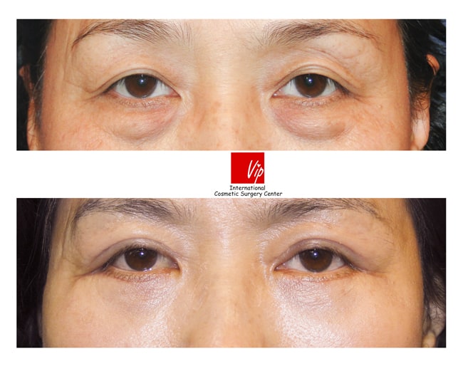 	Eye Surgery, Double Fold, Lower Blepharoplasty	 - Lower eyelid blepharoplasty