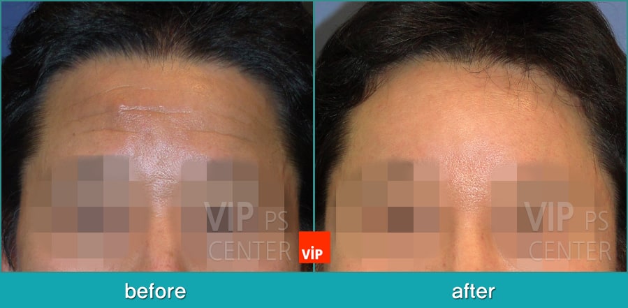 	Face Lift, Stem Cell Fat Graft	 - Forehead endscope lift