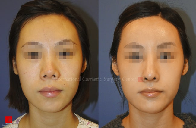 	Harmony-Rhinoplasty, Protruded Mouth Correction Rhinoplasty, Rib cartilage Rhinoplasty, Contracted Nose, Revision Rhinoplasty	 - Harmony rhinoplasty