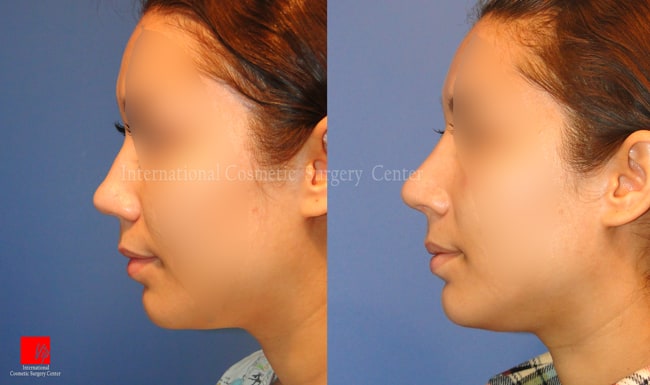 	Nose Surgery, Harmony-Rhinoplasty, Rib cartilage Rhinoplasty	 - Bulbous and big nose