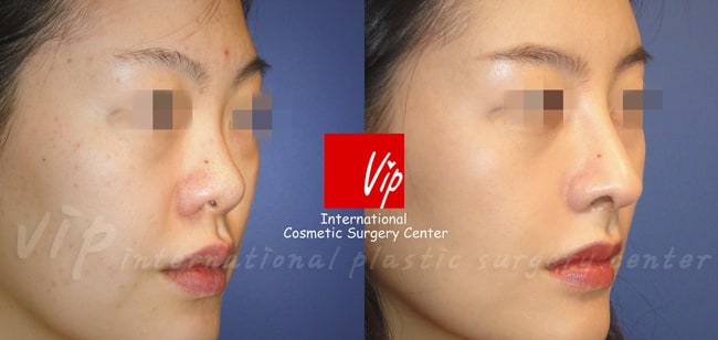 	Harmony-Rhinoplasty, Protruded Mouth Correction Rhinoplasty, Rib cartilage Rhinoplasty	 - Ribcartilage rhinoplasty