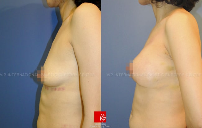 	Breast Surgery, Body Contouring	 - Tear drop breast augmentation