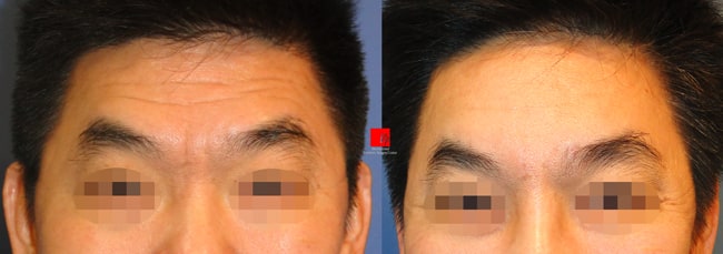	Face Lift	 - Forehead endoscope surgery-improvement of deep wrinkles