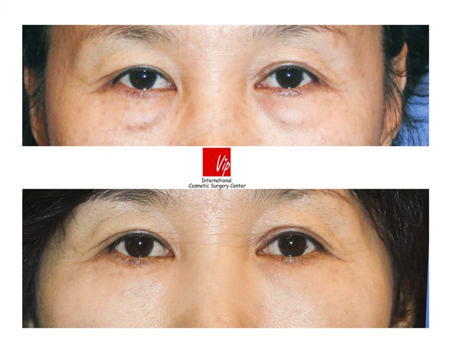 	Lower Blepharoplasty	 - Lower eyelid blepharoplasty (eye bag removal)