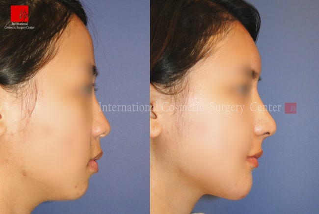 	Nose Surgery, Rib cartilage Rhinoplasty, Stem Cell Fat Graft	 - Autologous Rhinoplasty and Fat graft