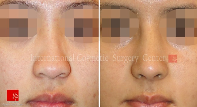	Nose Surgery, Rib cartilage Rhinoplasty, Stem Cell Fat Graft	 - Autologous Rhinoplasty and Fat graft
