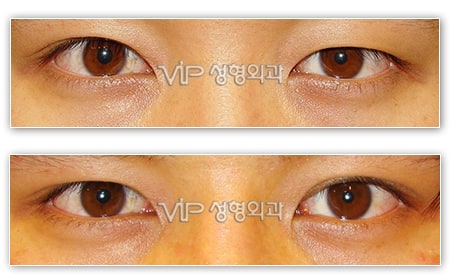 Eye Surgery - Double eyelid surgery