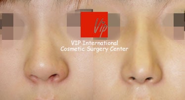 	Rib cartilage Rhinoplasty, Revision Rhinoplasty, Each Cases Nose	 - Autologous rhinoplasty