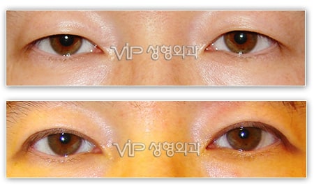 Eye Surgery - Upper blepharoplasty