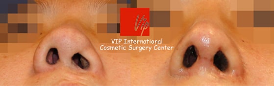 	Nose Surgery, Rib cartilage Rhinoplasty, Each Cases Nose	 - Cleft lip correction - Rib cartilage rhinoplasty