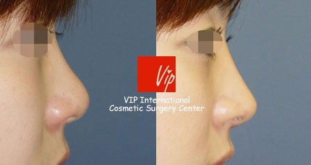 	Rib cartilage Rhinoplasty, Revision Rhinoplasty, Each Cases Nose	 - Autologous rhinoplasty