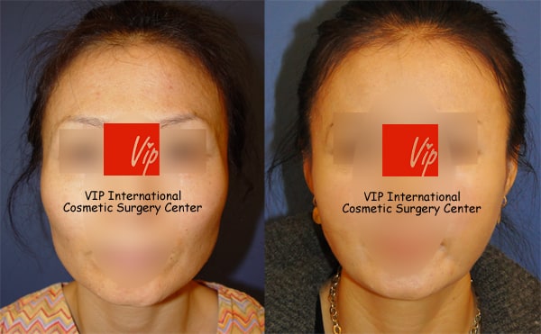 	Stem Cell Fat Graft	 - Temple & cheek Fat graft