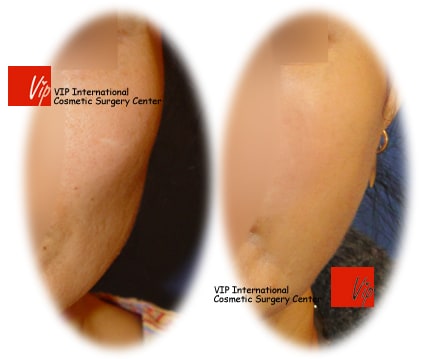 	Stem Cell Fat Graft	 - Temple & cheek Fat graft