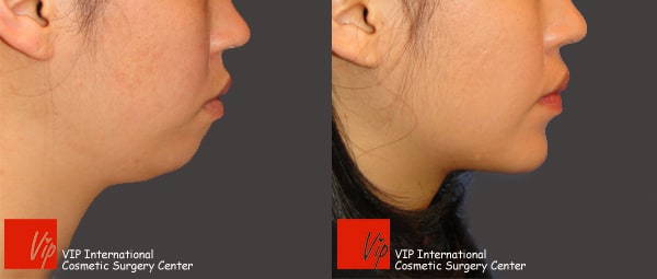 Facial Bone Surgery - Genioplasty - bringing chin bone forward