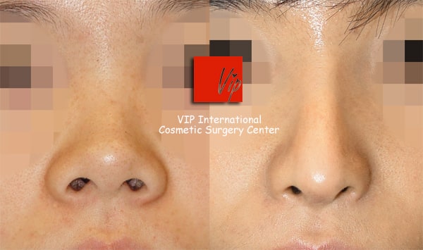 	Harmony-Rhinoplasty, Protruded Mouth Correction Rhinoplasty, Rib cartilage Rhinoplasty	 - VIP Harmony rhinoplasty ( small, upturned & protruded mouth correction )