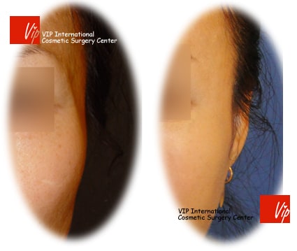 	Stem Cell Fat Graft	 - Temple & cheek Fat graft