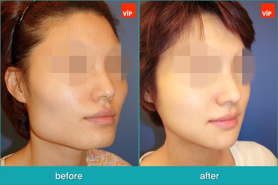 	Nose Surgery, Septal Deviation, Facial Bone Surgery	 - Septal Cartilage Rhinoplasty, Face Contouring Surgery, V-line Surgery, Cheekbone Reduction