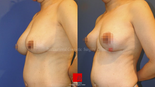 	Breast Surgery	 - Breast lift