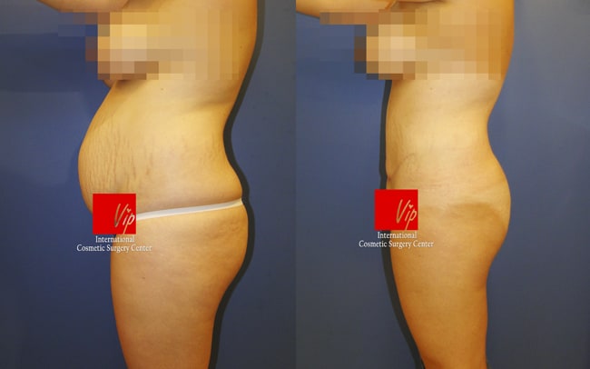 	Body Contouring	 - Abdominal surgery with liposuction