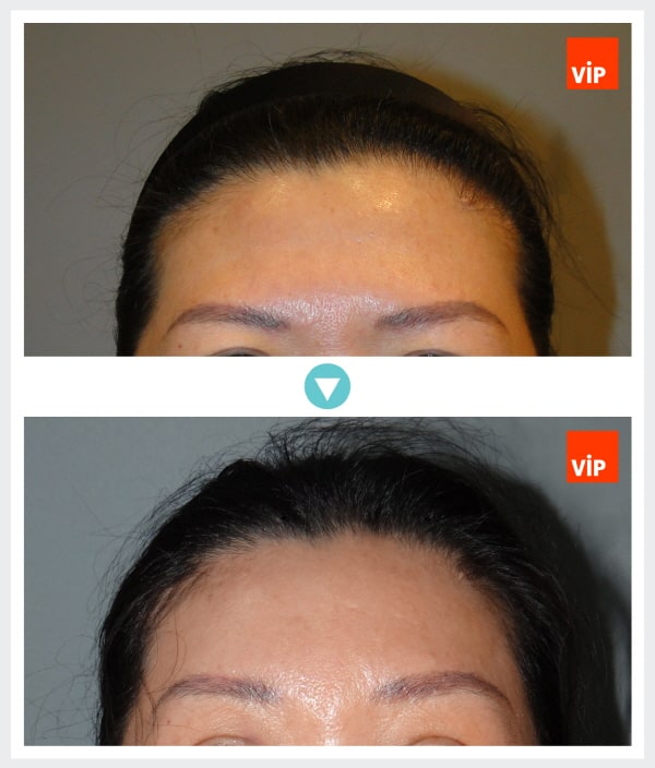 Face Lift - Endoscopic Forehead Lift