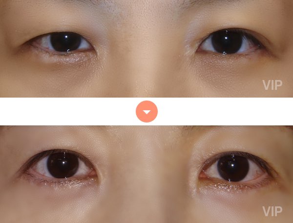 Eye Surgery - Double Eyelid Surgery