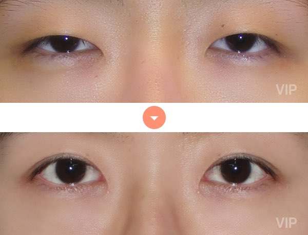 Eye Surgery - Double Eyelid Surgery