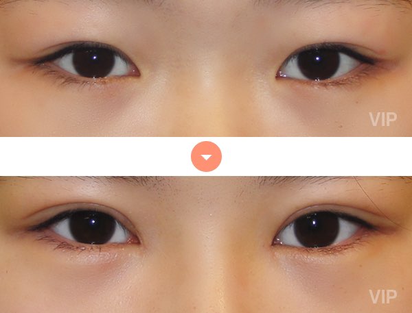 Eye Surgery - Double Eyelid Surgery