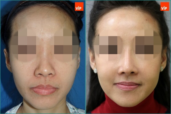 Nose Surgery - Rhinoplasty