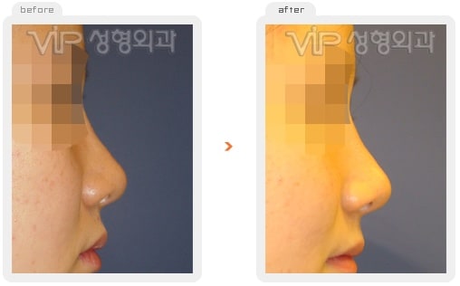 	Nose Surgery, Rib cartilage Rhinoplasty	 - Rib cartilage rhinoplasty