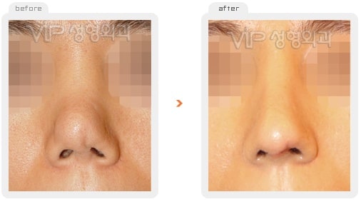 Nose Surgery - Revision rhinoplasty