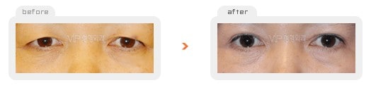 	Eye Surgery	 - Upper & Lower blepharoplasty