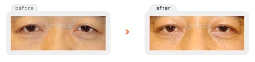 	Eye Surgery	 - Upper & Lower blepharoplasty