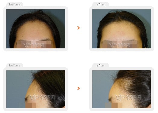 Stem Cell Fat Graft - Fat graft - forehead & temple