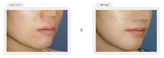Stem Cell Fat Graft - Fat graft - front chin